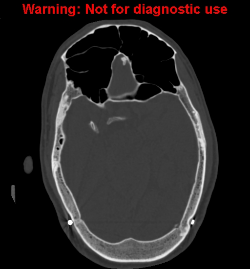 File:Calvarial thickening from chronic shunting (Radiopaedia 60079-67637 Axial bone window 74).jpg