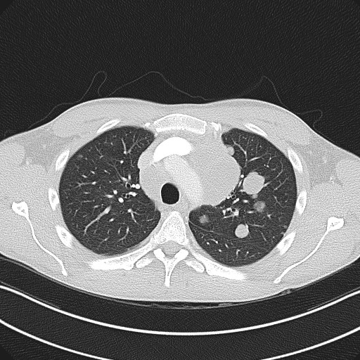 File:Cannonball metastases - testicular choriocarcinoma (Radiopaedia 84510-99891 Axial lung window 31).jpg