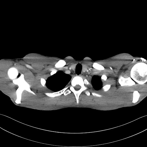 File:Cannonball metastases - testicular choriocarcinoma (Radiopaedia 84510-99891 B 20).jpg