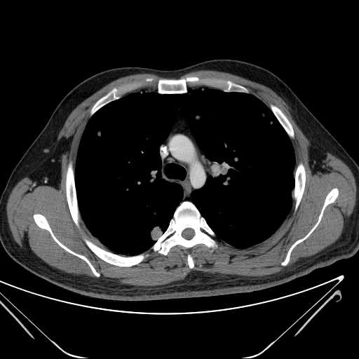 File:Cannonball pulmonary metastases (Radiopaedia 67684-77101 D 99).jpg