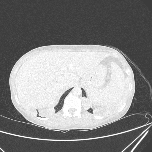 Canonball lung metastasis (Radiopaedia 77634-89837 Axial lung window 167).jpg