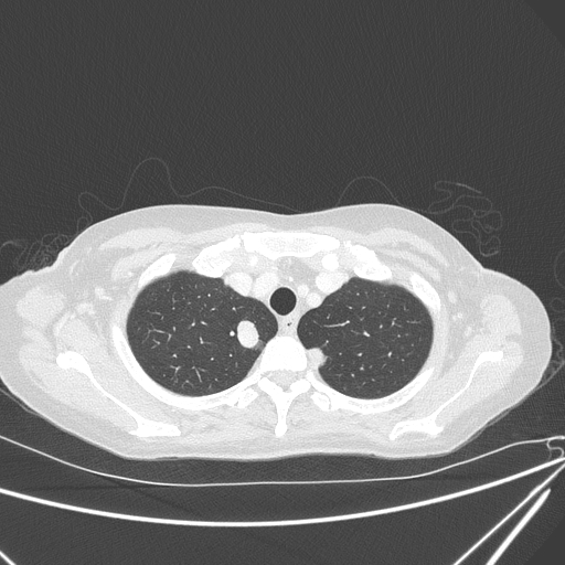 File:Canonball lung metastasis (Radiopaedia 77634-89837 Axial lung window 31).jpg