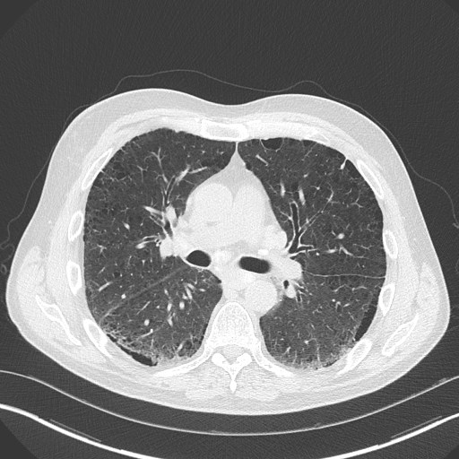 Caplan syndrome (Radiopaedia 56667-63530 Axial lung window 95).jpg