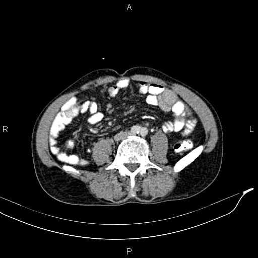 Caput medusae sign - portal hypertension (Radiopaedia 64007-72759 A 59).jpg