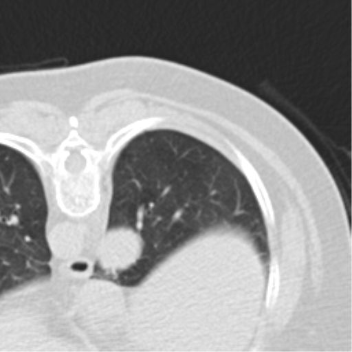File:Carcinoid tumor - lung (Radiopaedia 44814-48644 Axial lung window 5).png
