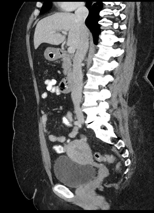 Carcinoid tumor - terminal ileum (Radiopaedia 60931-68739 C 54).jpg