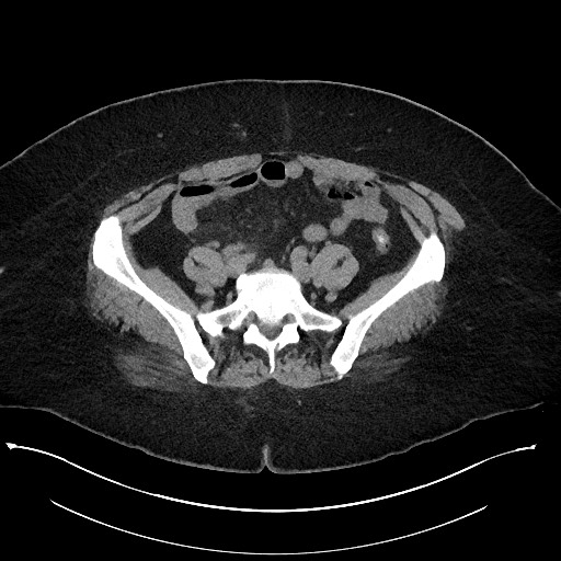 Carcinoid tumor - terminal ileum (Radiopaedia 60931-68740 Axial non-contrast 83).jpg