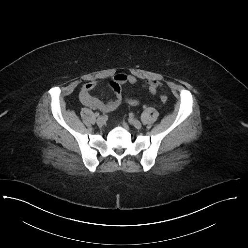 File:Carcinoid tumor - terminal ileum (Radiopaedia 60931-68740 Axial non-contrast 88).jpg