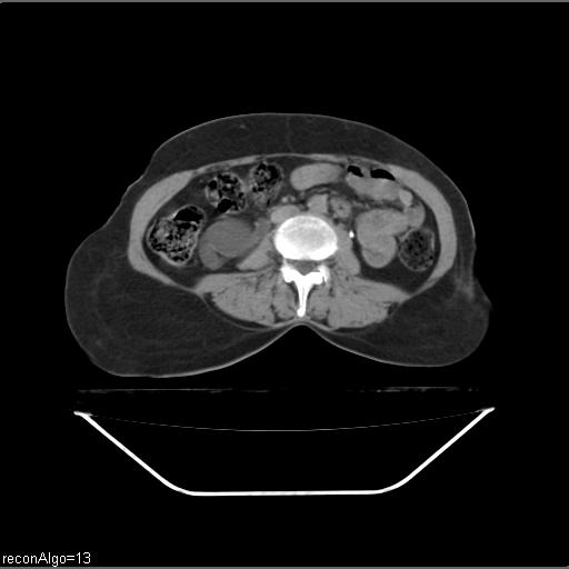 File:Carcinoma cervix- recurrence (Radiopaedia 34702-36137 B 80).jpg