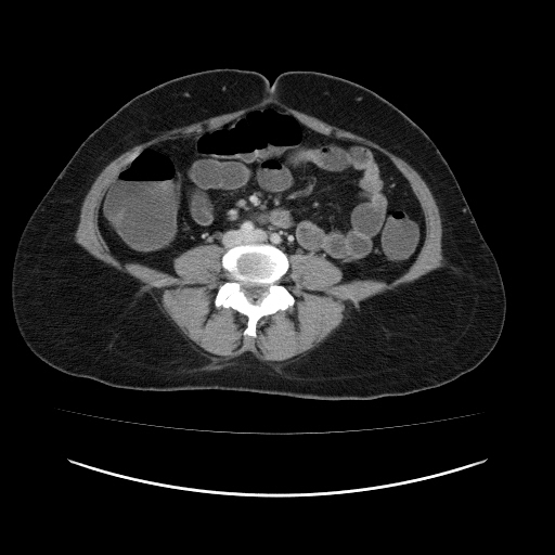 File:Carcinoma colon - hepatic flexure (Radiopaedia 19461-19493 A 79).jpg