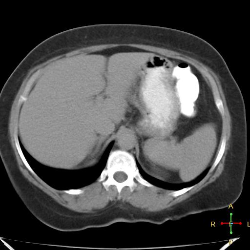 File:Carcinoma of sigmoid colon (Radiopaedia 23071-23100 C+ delayed 4).jpg