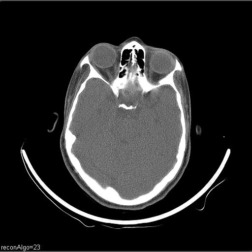File:Carcinoma of the maxillary antrum (Radiopaedia 53805-59888 Axial non-contrast 75).jpg