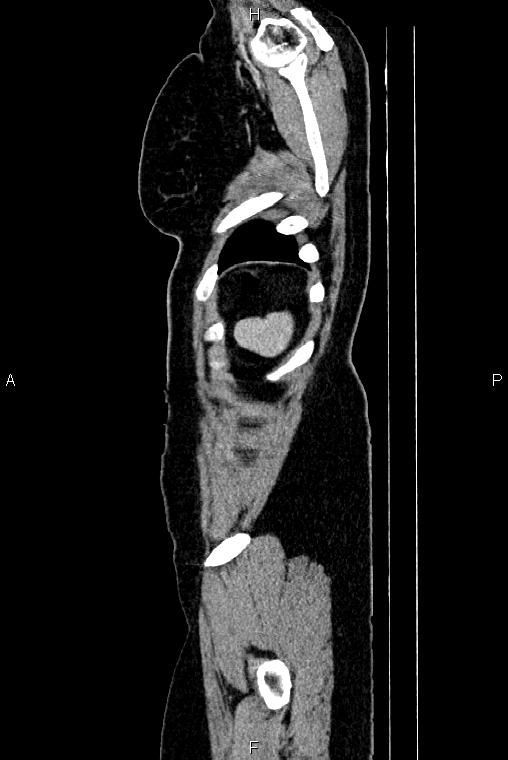 Carcinoma of uterine cervix (Radiopaedia 85861-101700 D 84).jpg