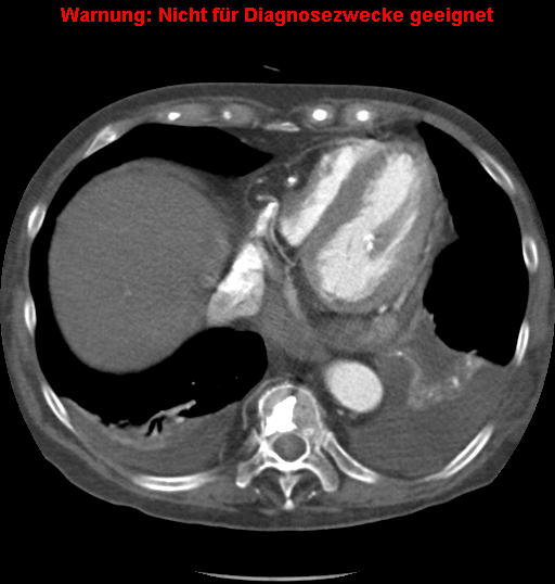 File:Cardiac perforation following transcatheter aortic valve implantation (Radiopaedia 23714-23863 A 13).png