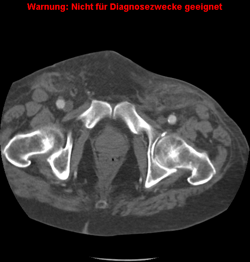 File:Cardiac perforation following transcatheter aortic valve implantation (Radiopaedia 23714-23863 B 10).png