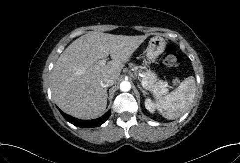 Cardiac sarcoidosis (Radiopaedia 74548-85534 A 90).jpg