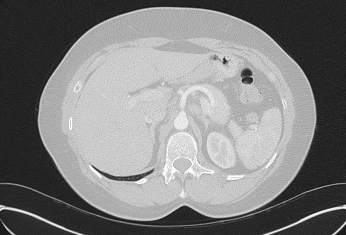 Cardiac sarcoidosis (Radiopaedia 74548-85534 Axial lung window 94).jpg
