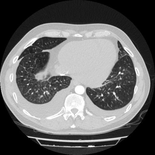 Cardiac tamponade (Radiopaedia 78607-91368 Axial lung window 70).jpg