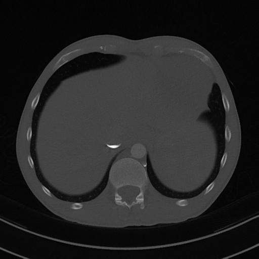 Cardiac tumor - undifferentiated pleomorphic sarcoma (Radiopaedia 45844-50134 Axial bone window 60).png