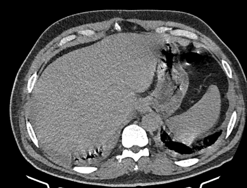Cardiogenic pulmonary edema (Radiopaedia 68180-77678 Axial non-contrast 50).jpg