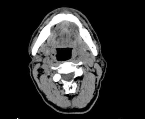 Carotid body tumor (Radiopaedia 61750-69757 Axial non-contrast 37).jpg