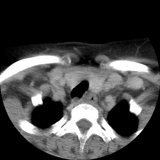 Carotid body tumor (paraganglioma) (Radiopaedia 38586-40729 A 65).jpg