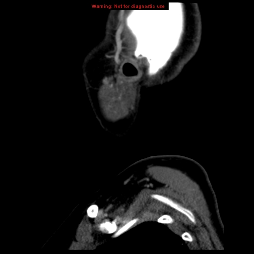 Carotid body tumor with lung metastases (Radiopaedia 9301-9986 Sagittal C+ delayed 51).jpg