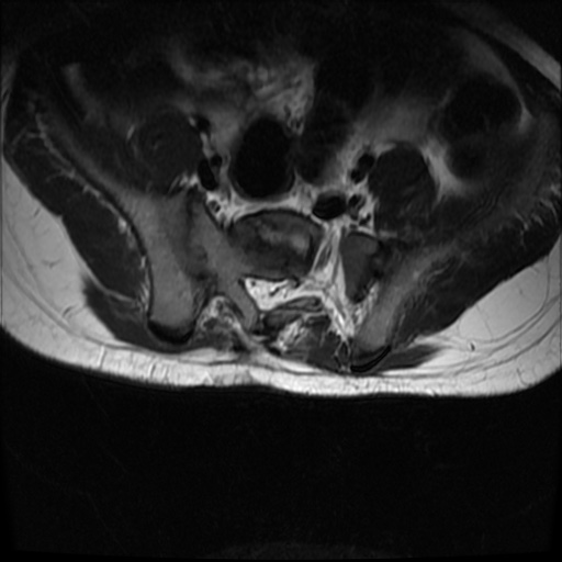 File:Caudal regression syndrome type 1 (Radiopaedia 82213-96267 Axial T2 21).jpg