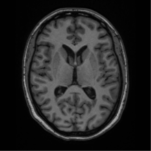 Cavernoma with bleed - midbrain (Radiopaedia 54546-60774 Axial T1 24).png