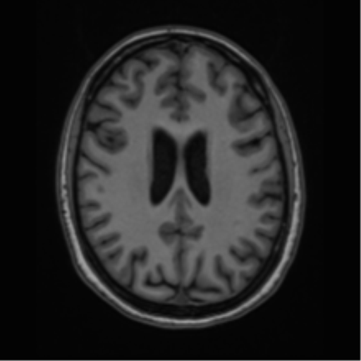 Cavernoma with bleed - midbrain (Radiopaedia 54546-60774 Axial T1 33).png