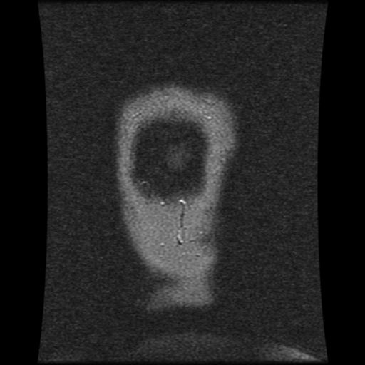 Cavernoma with developmental venous anomaly (Radiopaedia 22470-22507 MRV 21).jpg