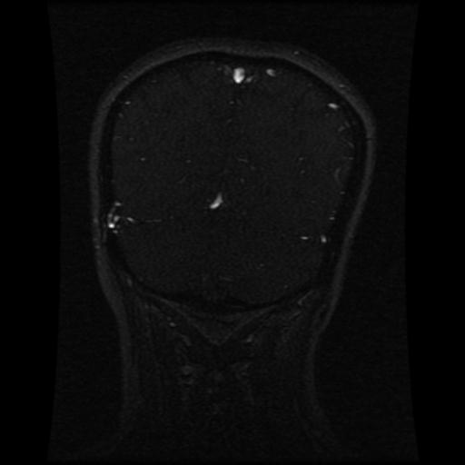 Cavernoma with developmental venous anomaly (Radiopaedia 22470-22507 MRV 42).jpg
