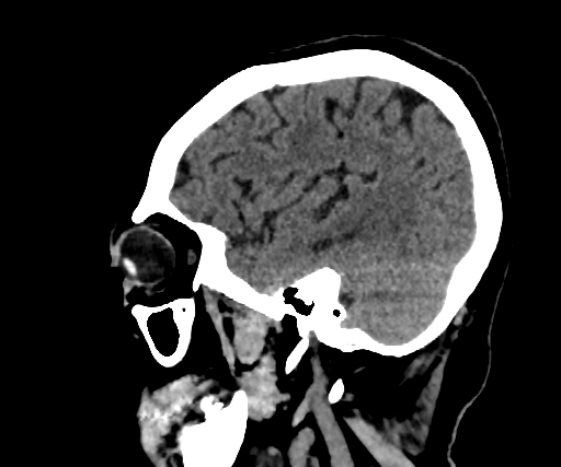 Cavernous hemangioma of the cerebellar falx (Radiopaedia 73025-83723 B 84).jpg
