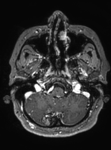 Cavernous hemangioma of the cerebellar falx (Radiopaedia 73025-83724 Axial T1 C+ 281).jpg