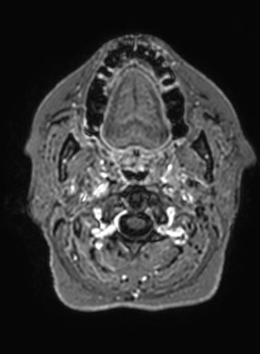 Cavernous hemangioma of the cerebellar falx (Radiopaedia 73025-83724 Axial T1 C+ 346).jpg