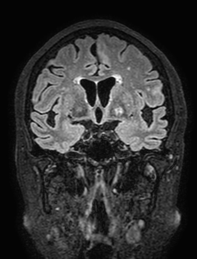Cavernous hemangioma of the cerebellar falx (Radiopaedia 73025-83724 Coronal FLAIR 147).jpg