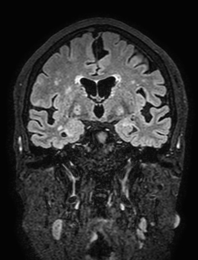 Cavernous hemangioma of the cerebellar falx (Radiopaedia 73025-83724 Coronal FLAIR 162).jpg
