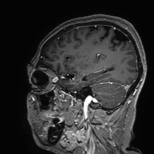 Cavernous hemangioma of the cerebellar falx (Radiopaedia 73025-83724 Sagittal T1 C+ 154).jpg