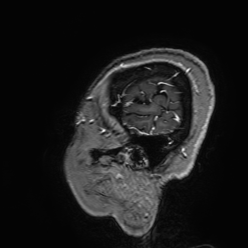 Cavernous hemangioma of the cerebellar falx (Radiopaedia 73025-83724 Sagittal T1 C+ 195).jpg