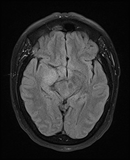 File:Cavernous sinus meningioma (Radiopaedia 63682-72367 Axial FLAIR 11).jpg