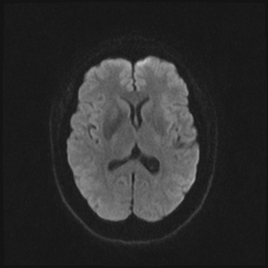 File:Cavernous sinus meningioma (Radiopaedia 63682-72367 DWI 53).jpg