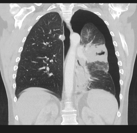 Cavitating pneumonia complicated by pneumothorax (Radiopaedia 48149-52994 Coronal lung window 37).png