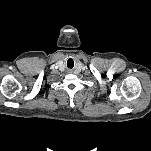 File:Cavitating right lower lobe tumor (Radiopaedia 13507).jpg
