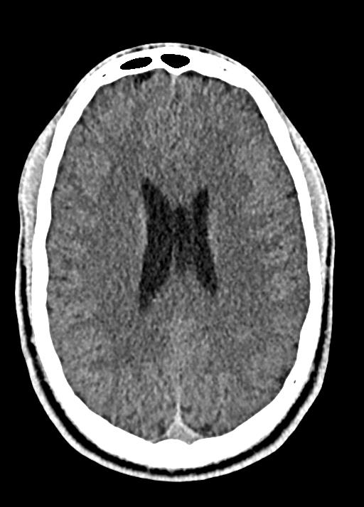 Cavum septum pellucidum and cavum vergae (Radiopaedia 77797-90060 Axial Brain Window 66).jpg