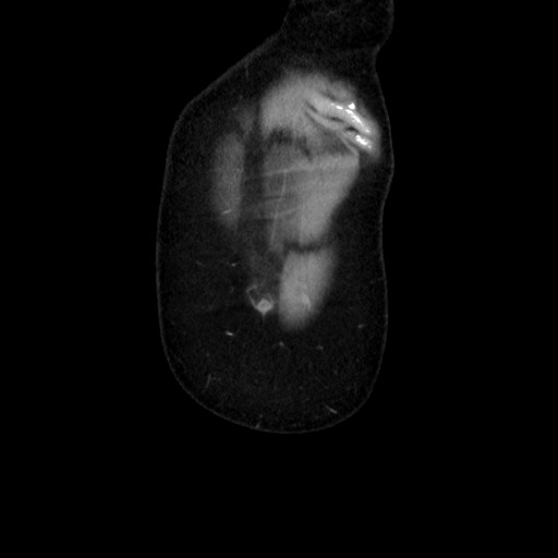 Cecal adenocarcinoma (Radiopaedia 75909-87331 B 7).jpg