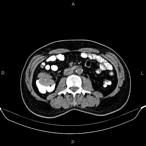 File:Cecal adenocarcinoma (Radiopaedia 85324-100916 Axial non-contrast 48).jpg