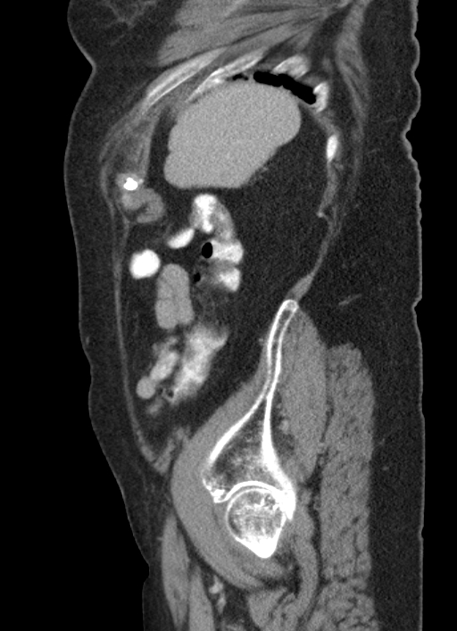 Cecal adenocarcinoma - surgical scar recurrence (Radiopaedia 79988-93264 D 13).jpg