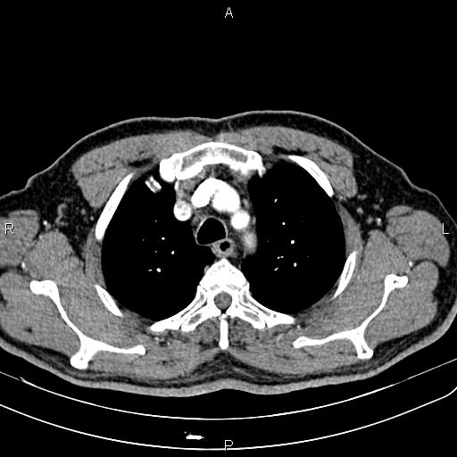File:Cecal cancer with appendiceal mucocele (Radiopaedia 91080-108651 A 18).jpg