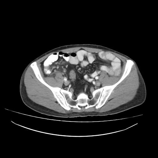 File:Cecal carcinoma with local lymphadenopathy (Radiopaedia 31428-32240 A 40).jpg