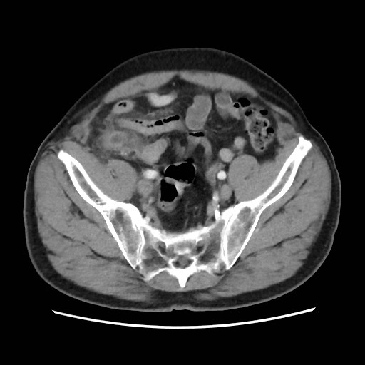 File:Cecal mass causing appendicitis (Radiopaedia 59207-66531 A 70).jpg